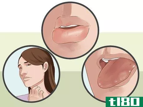 Image titled Diagnose Oral Allergy Syndrome Step 1