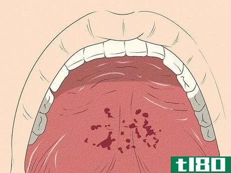 Image titled Differentiate Bacterial Tonsillitis and Viral Tonsillitis Step 5