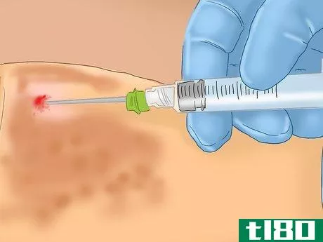 Image titled Diagnose Typhoid Fever Step 5