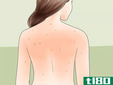 Image titled Diagnose Measles Step 4