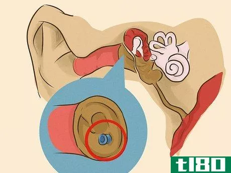 Image titled Drain Ear Fluid Step 17