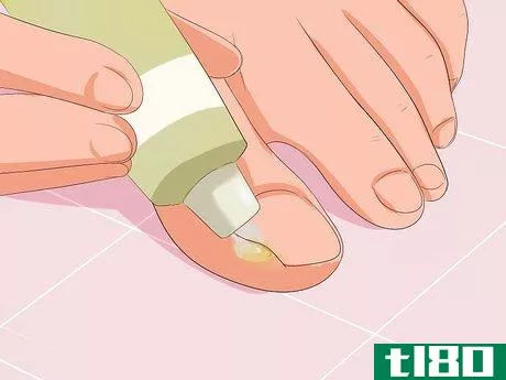 Image titled Remove Infection from an Ingrown Toenail Step 3