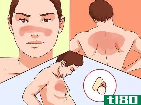 Image titled Diagnose Lupus Step 17