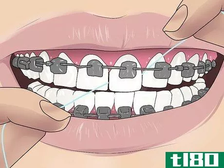 Image titled Floss With Braces Step 9