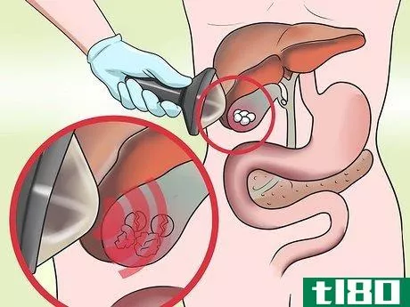 Image titled Dissolve Gallstones Step 3