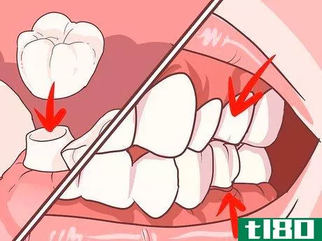 Image titled Fix a Lost Dental Crown Step 8