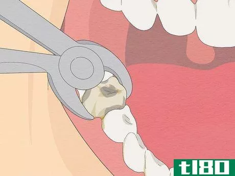 Image titled Fix Rotting Teeth Step 6