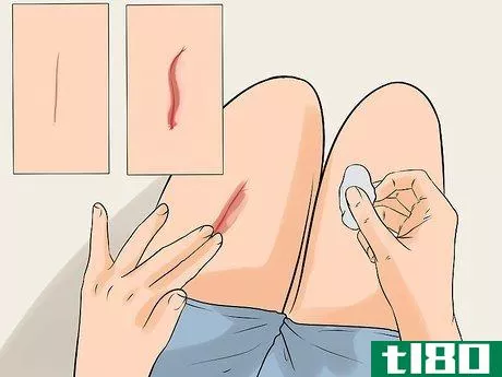 Image titled Determine if a Cut Needs Stitches Step 7