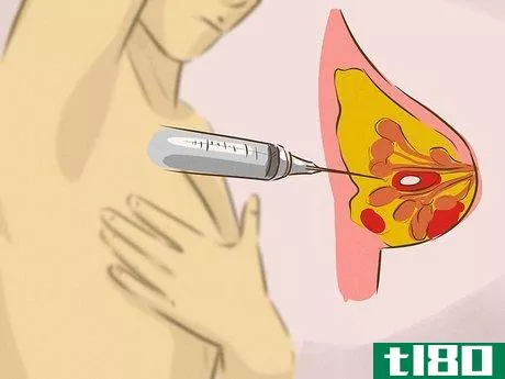 Image titled Treat Breast Cysts Step 10