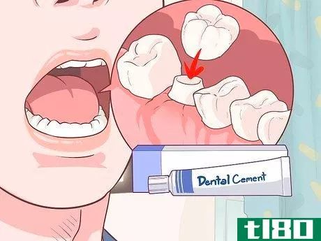 Image titled Fix a Lost Dental Crown Step 1