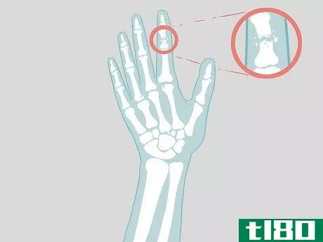 Image titled Determine if a Finger Is Broken Step 16
