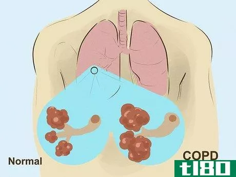 Image titled Diagnose Lung Hyperinflation Step 8