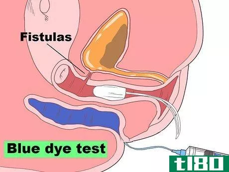 Image titled Diagnose a Fistula Step 11