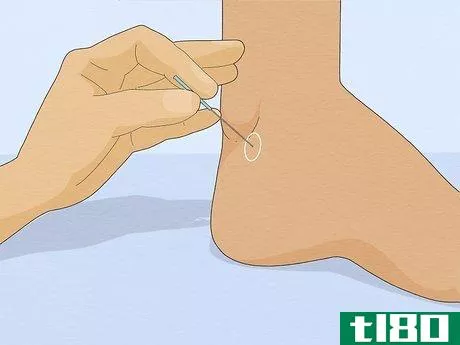 Image titled Ease Constipation with Acupuncture Step 2