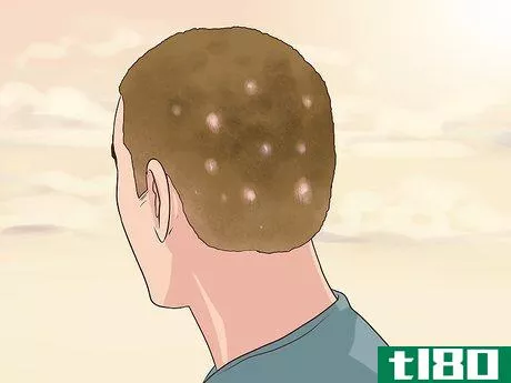 Image titled Diagnose Scalp Psoriasis Step 14