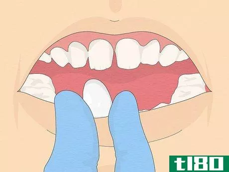 Image titled Fix Crooked Teeth Step 12