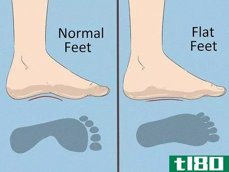 Image titled Fix Flat Feet Step 1