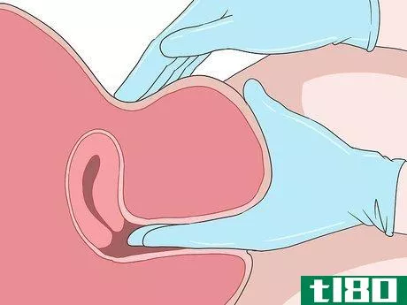 Image titled Do a Pap Smear Step 10