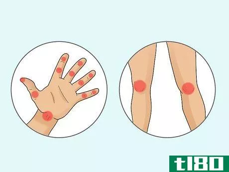 Image titled Diagnose Rheumatoid Arthritis Step 2