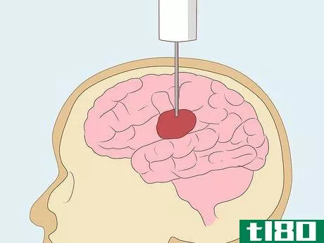 Image titled Detect Brain Cancer Step 11