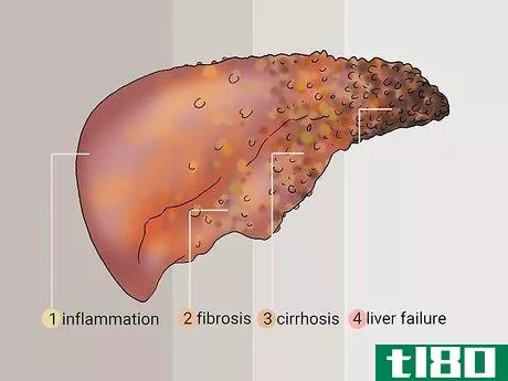 Image titled Diagnose Liver Fibrosis Step 13