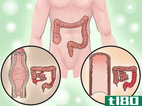 Image titled Distinguish Ulcerative Colitis from Similar Conditions Step 7