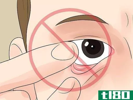 Image titled Diagnose Pink Eye Step 10