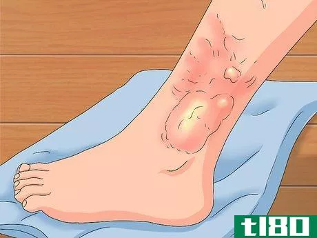 Image titled Determine if a Burn Is Infected Step 4