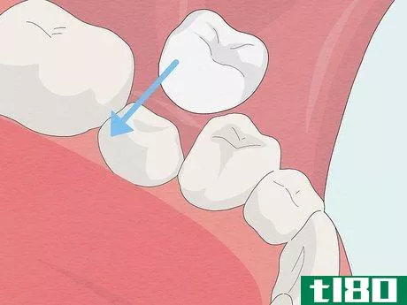 Image titled Fix Rotting Teeth Step 4