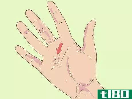 Image titled Diagnose Dupuytren's Contracture Step 1