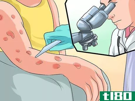 Image titled Diagnose Scabies Step 9