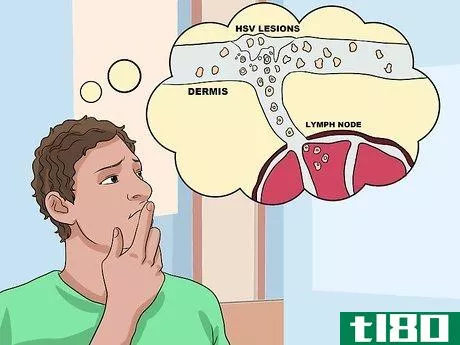 Image titled Ease Herpes Pain with Home Remedies Step 36