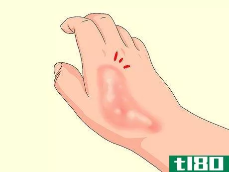 Image titled Determine if a Burn Is Infected Step 1