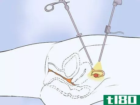 Image titled Detect Ovarian Cancer Step 7