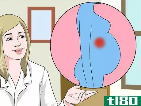 Image titled Detect Appendicitis During Pregnancy Step 3