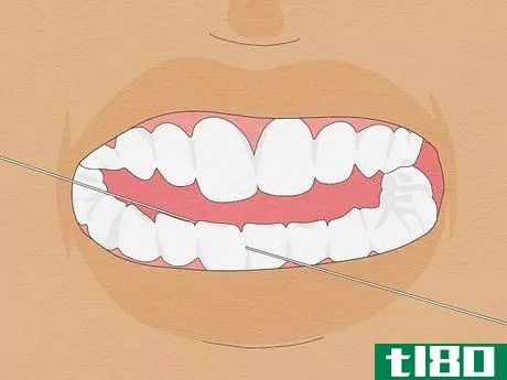 Image titled Fix Crooked Teeth Step 28