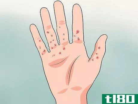 Image titled Diagnose Scabies Step 4