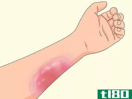 Image titled Determine if a Burn Is Infected Step 2