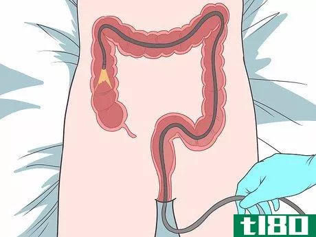 Image titled Diagnose a Fistula Step 9