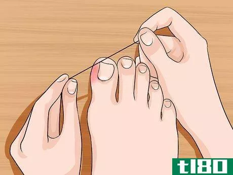 Image titled Relieve Ingrown Toe Nail Pain Step 8
