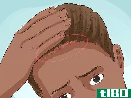 Image titled Diagnose Scalp Psoriasis Step 13