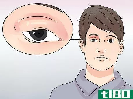 Image titled Diagnose Pink Eye Step 1