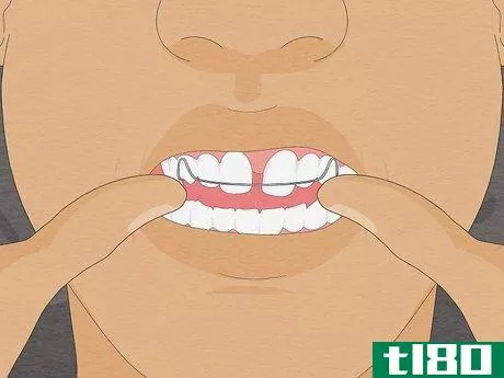 Image titled Fix Crooked Teeth Step 7