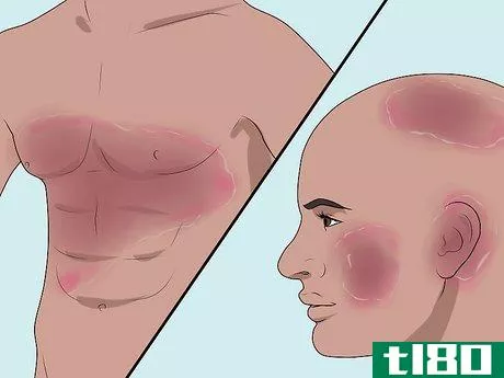 Image titled Diagnose Erythrodermic Psoriasis Step 9