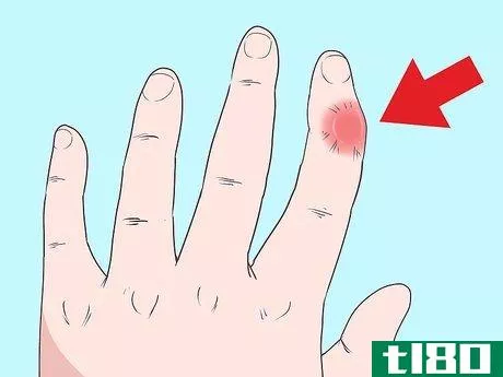 如何修复脱臼的手指(fix a dislocated finger)