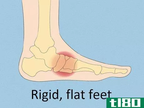 Image titled Fix Flat Feet Step 3