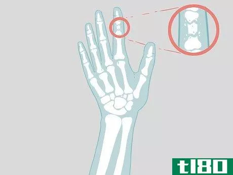 Image titled Determine if a Finger Is Broken Step 18