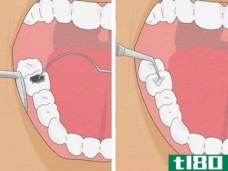 Image titled Fix Rotting Teeth Step 3