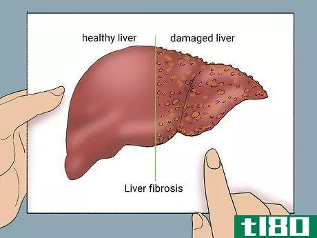Image titled Diagnose Liver Fibrosis Step 1