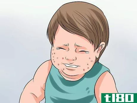 Image titled Diagnose Scabies Step 5
